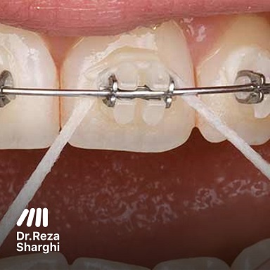 متخصص ارتودنسی: نخ دندان ارتودنسی
