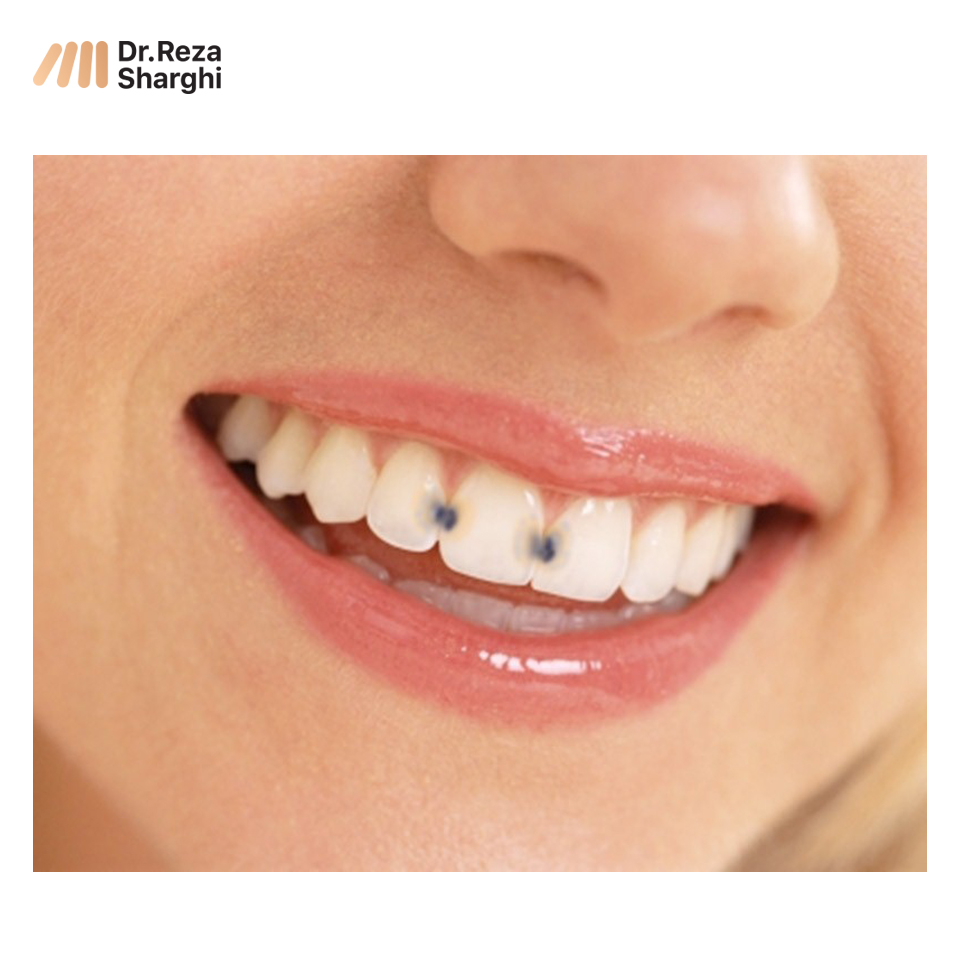 آیا ارتودنسی موجب پوسیدگی دندان میشود؟
